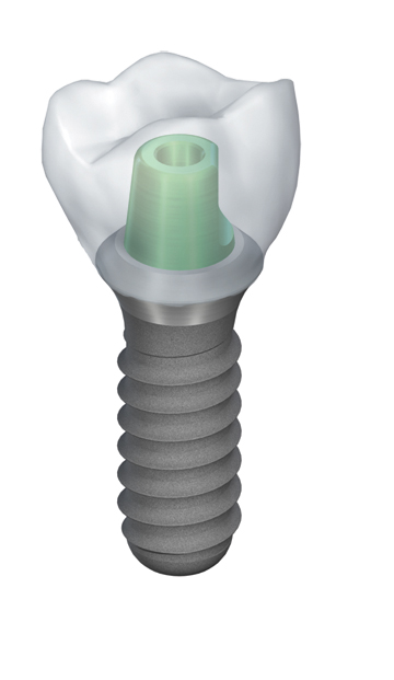 implant abutment & crown