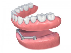 bar supported denture
